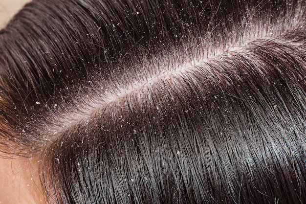 Dandruff Treatment